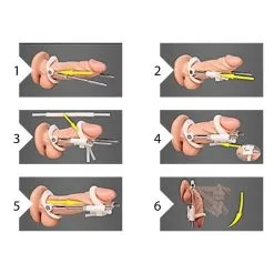 Pumped Extenseur De Pénis EXTENDER Noir 8 Pumped Extenseur De Pénis EXTENDER Noir -FÉMINITÉS boutique extenseur de penis extender noir 3